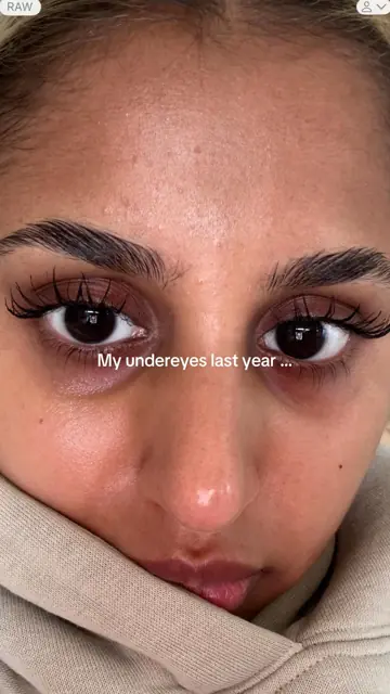 First slide: My undereyes last year ...